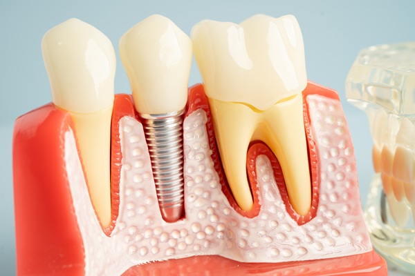 How An Implant Dentist Places An Artificial Tooth Root